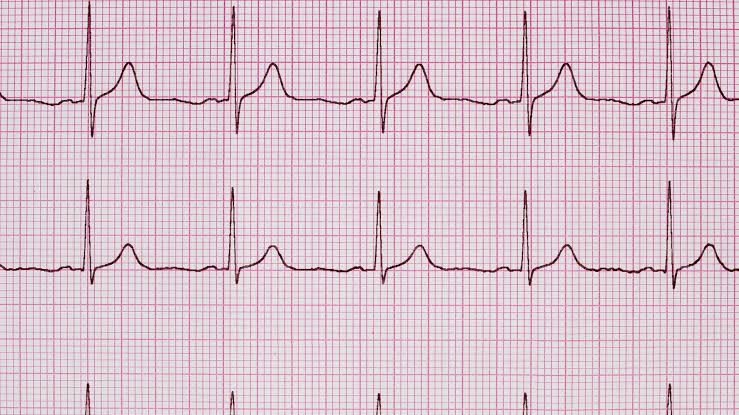Electrocardiogram (ECG / EKG)