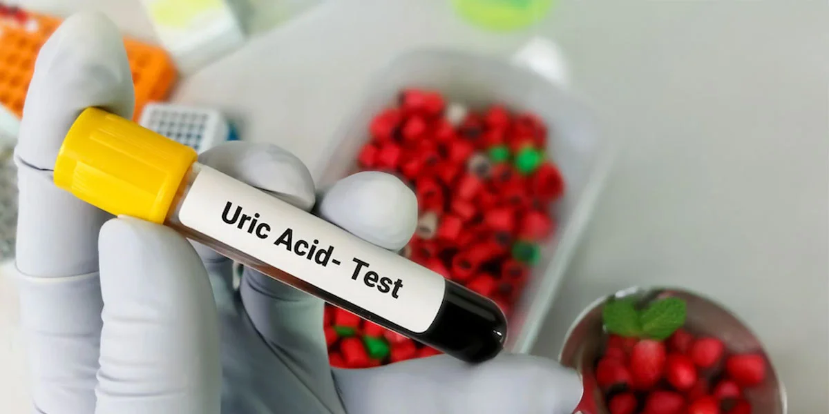 Serum Uric Acid